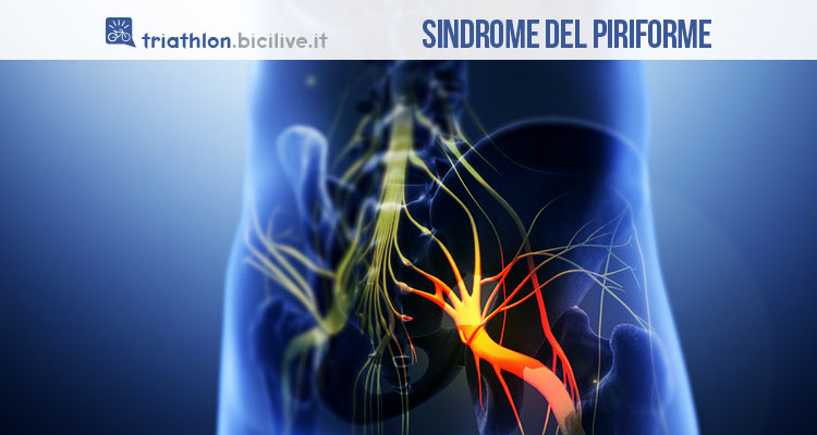 Sindrome del piriforme: cos’è e come si cura